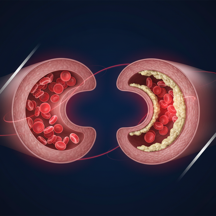 Plaque Control: What's Building Up in Your Arteries — and What You Can Do About It