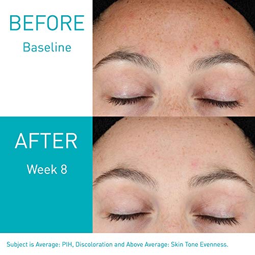 CeraVe 1 Oz Retinol Serum for Post-Acne Marks and Skin Texture