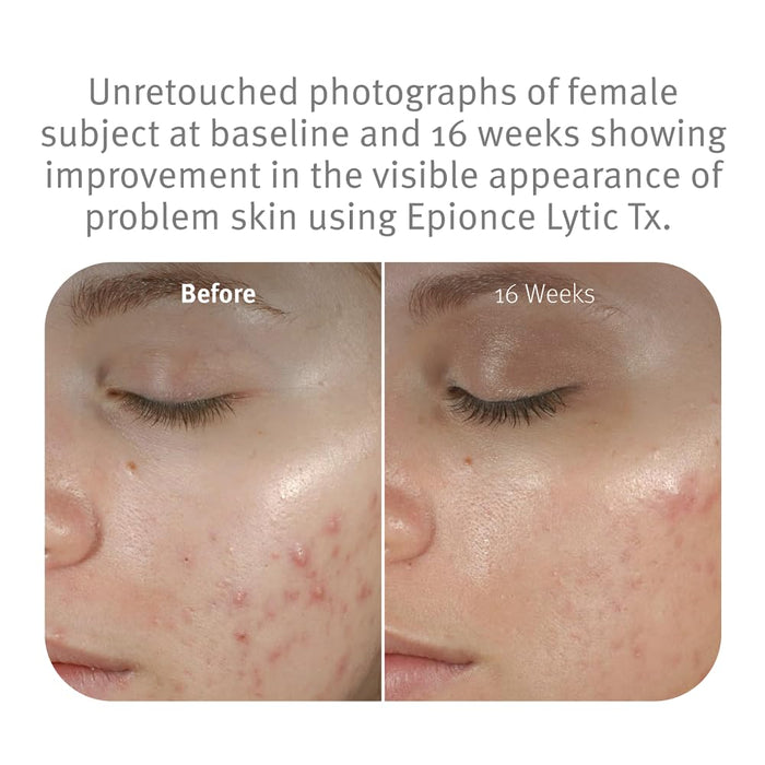 Epionce Lytic Tx Product for Normal to Combination Skin 40mL (1.4 fl oz)
