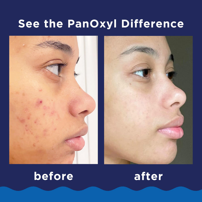 PanOxyl Acne Foaming Wash | 10% Benzoyl Peroxide - Face & Body 3 oz