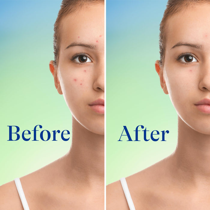 Differin Acne Foaming Cleanser with 10% Benzoyl Peroxide 5 oz.