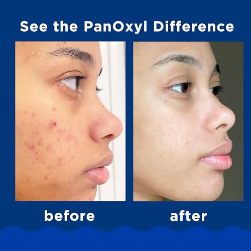 PanOxyl Acne Foaming Wash Benzoyl Peroxide 10% 5.5 Oz